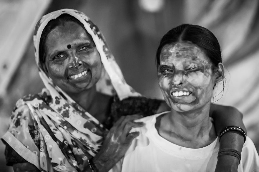 portraits-of-acid-attacks-survivors-in-india-sheroes-hangout